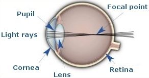 Nearsightedness Explained By Dr. Jeffrey T. Liegner, Md., Ophthalmologist